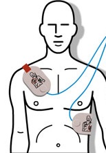 aed pad placement